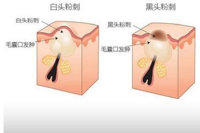 直播欧洲杯怎么去黑头产品:直播的欧洲杯